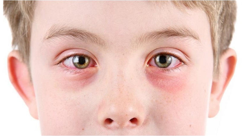 دلایل قرمزی چشم در کودکان و راه درمان آن
